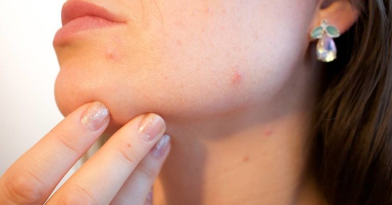 Cannabidiol and skin care treatments
