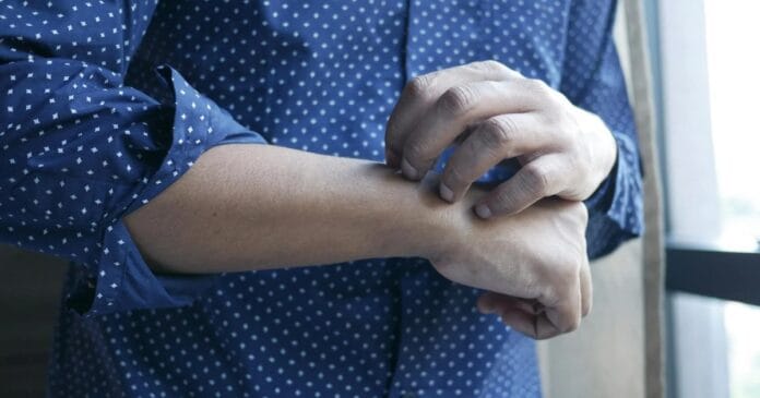 Cannabinoid treatment for atopic dermatitis