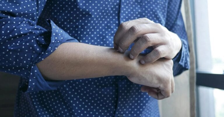 Cannabinoid treatment for atopic dermatitis