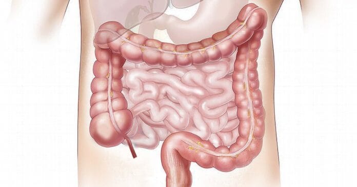 Colon cancer and cannabis use disorder
