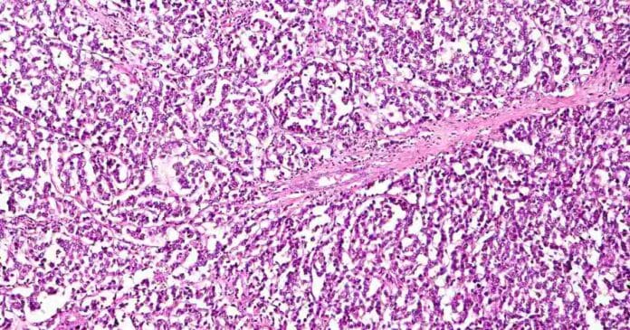 Ovarian cancer cells