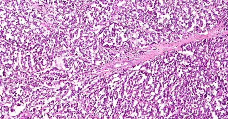 Ovarian cancer cells